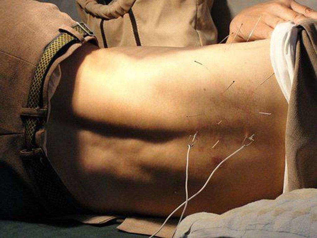 acupuncture for back pain