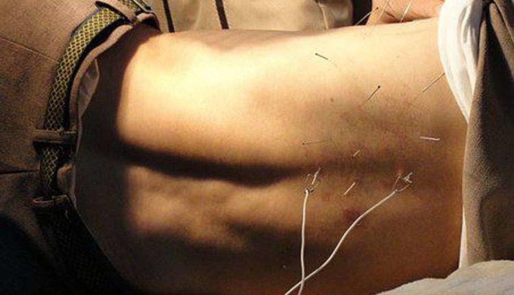acupuncture for back pain
